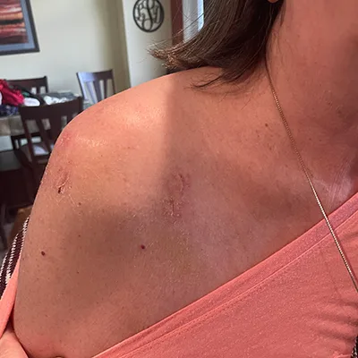 Laser Therapy Laser Therapy