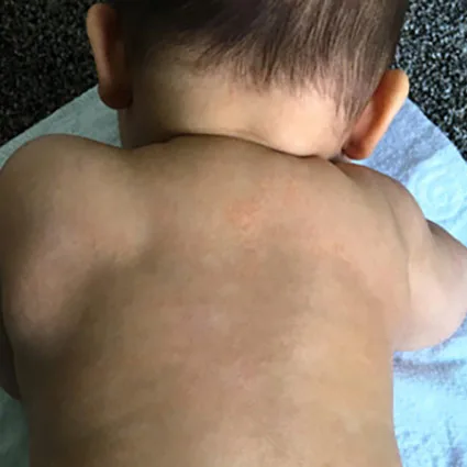 Clara with clear, healthy skin after chiropractic care